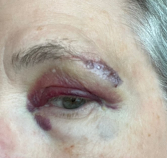 close up of a bruised black eye with purple glue on the eyebrow